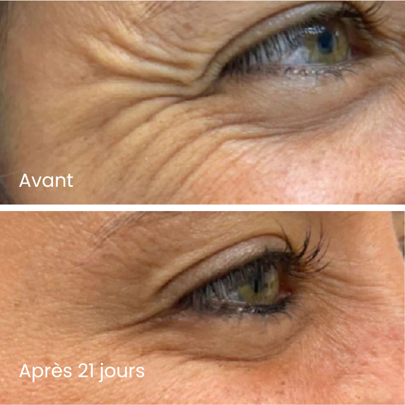 Patchs Micro-Infusion